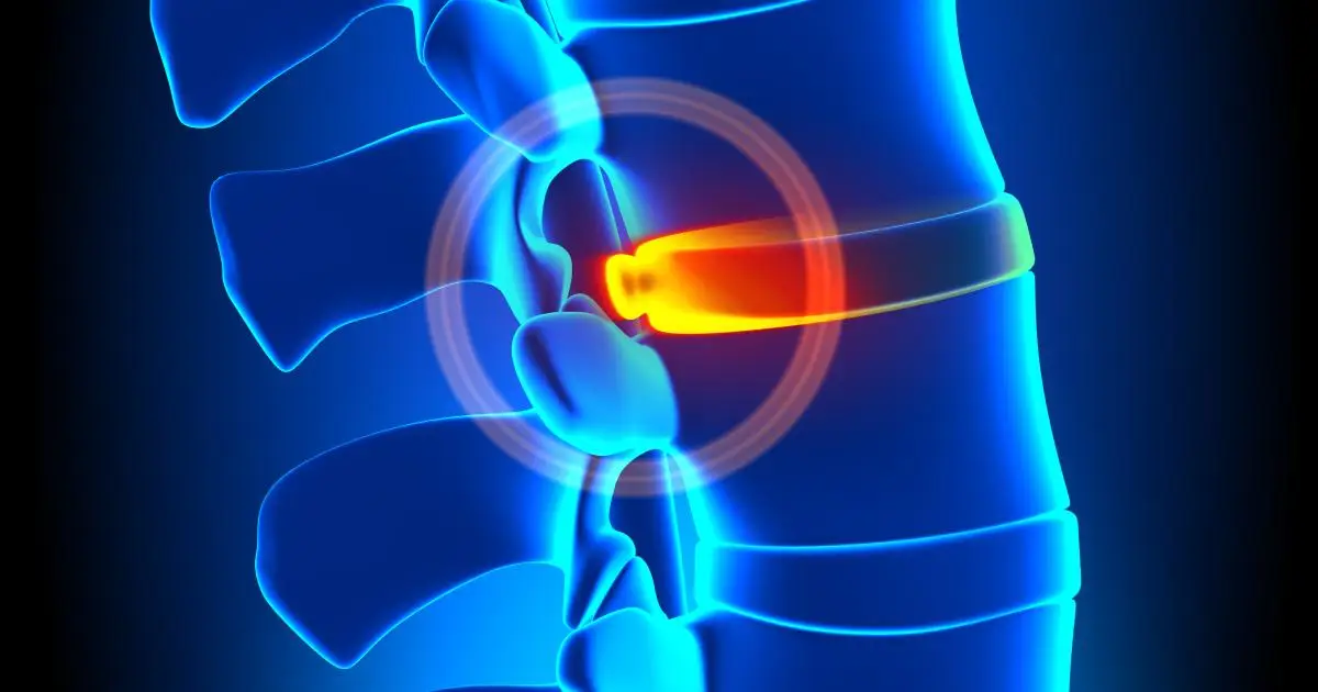 برای دیسک کمر چی خوبه