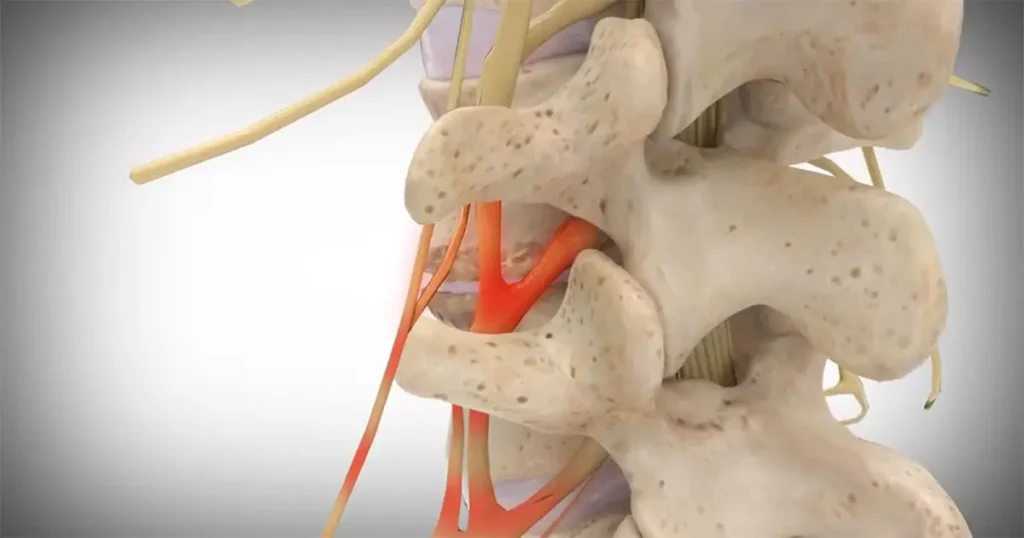 برای دیسک کمر چی خوبه